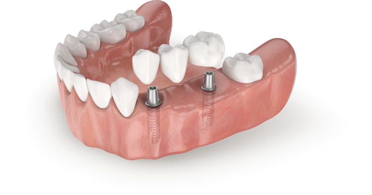 prótesis dentales