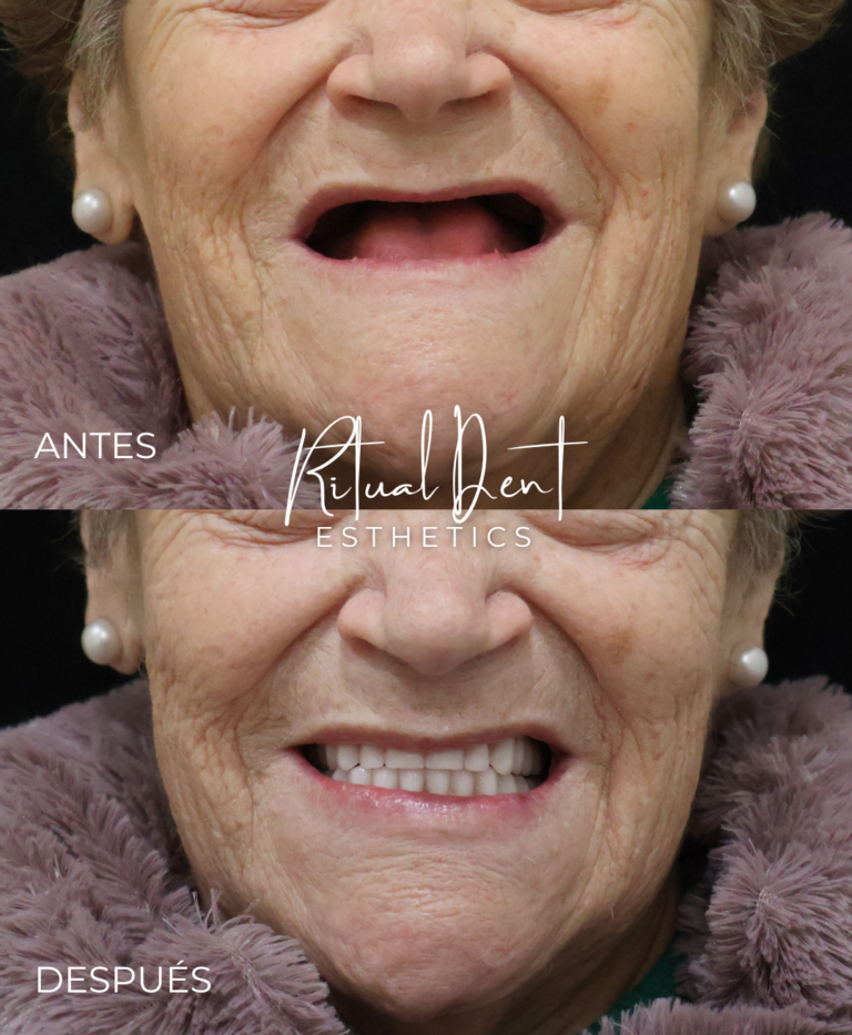 prótesis dental en Málaga
