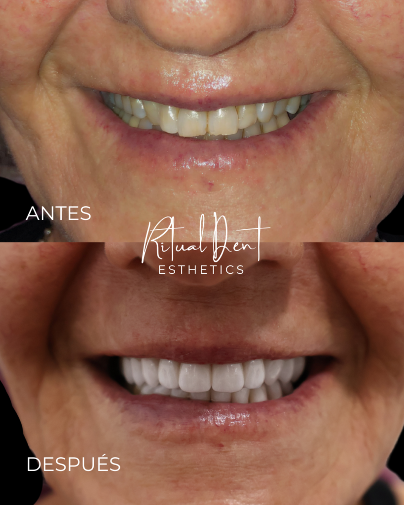 esthetic veeners in malaga
