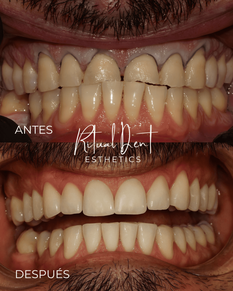 diseño de sonrisa en malaga