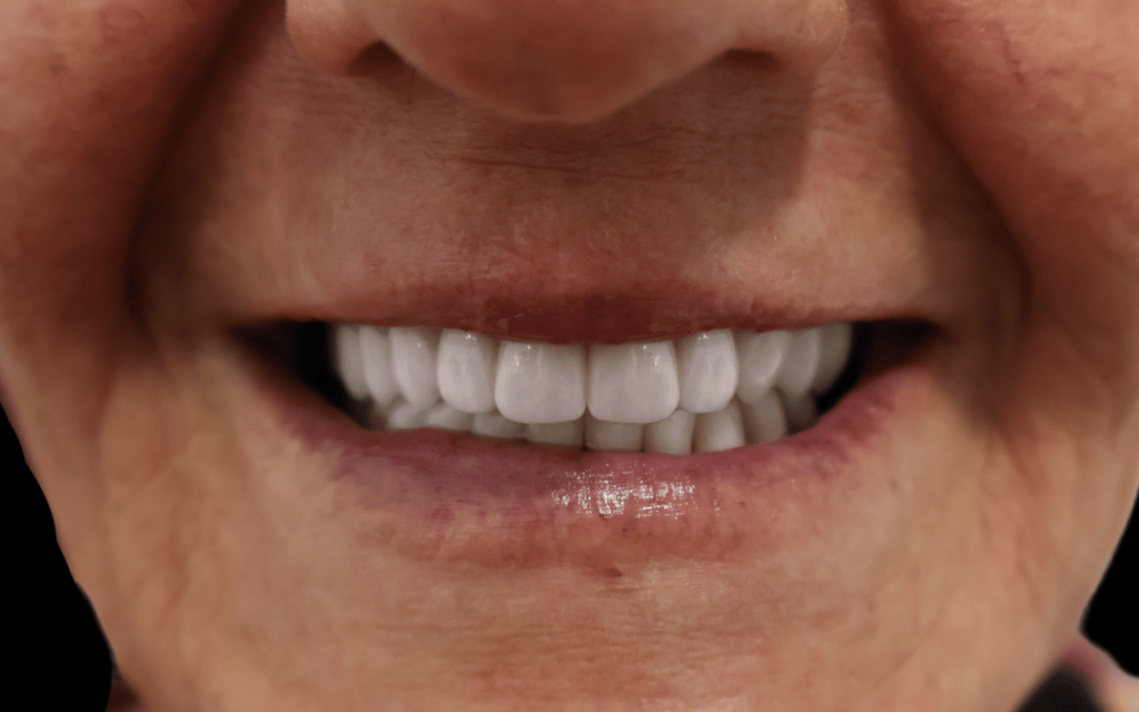carillas dentales