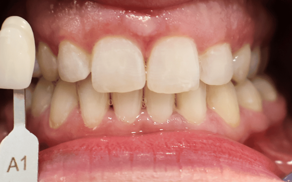 blanqueamiento dental