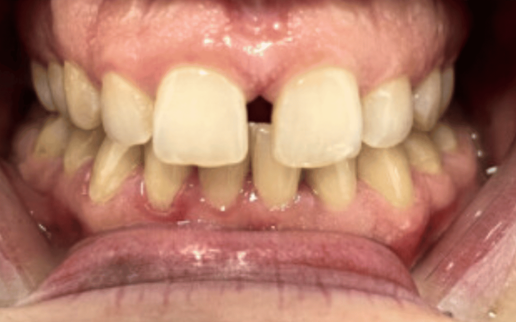 Invisalign