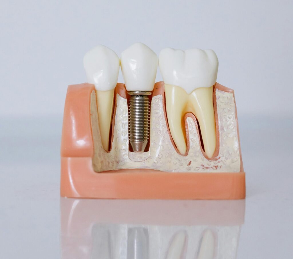 ¿Cuál es el precio de un implante dental en Málaga?